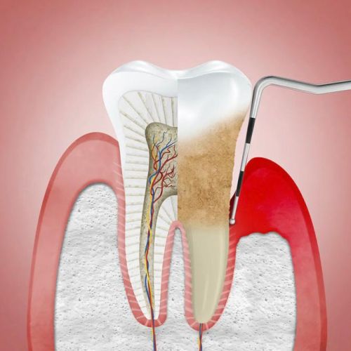 PERIODONTAL THERAPY Cornwall