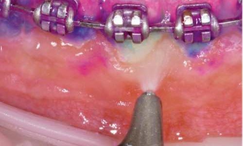 orthodontic clean with Airflow